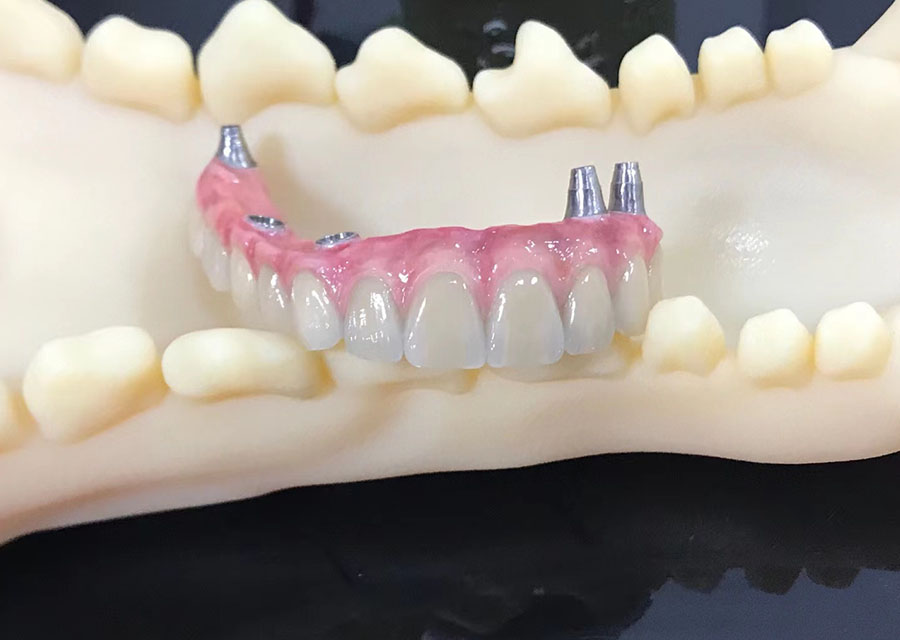 Screw-Retained Fixed Hybrid Prosthesis