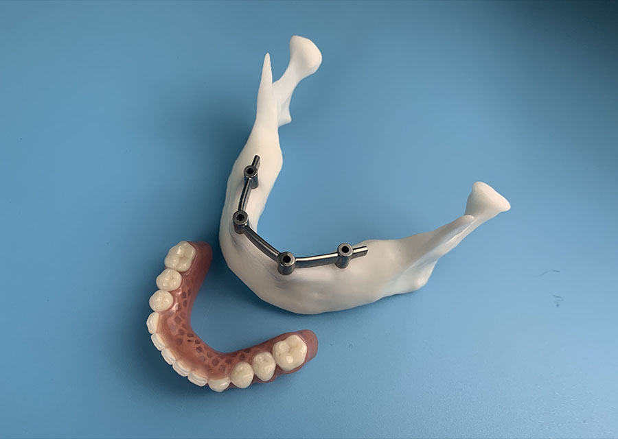 Bar Overdenture