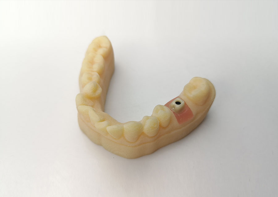 Custom Zirconia Abutment