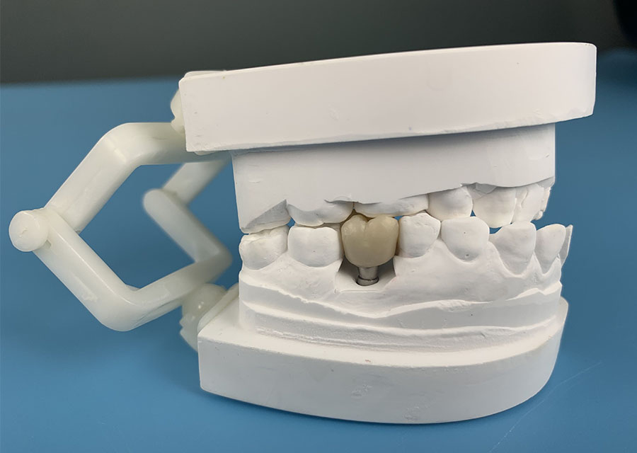 Full Zirconia Screw Retained