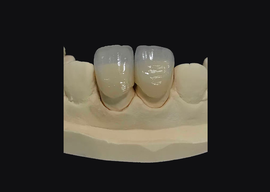 IPS Veneer